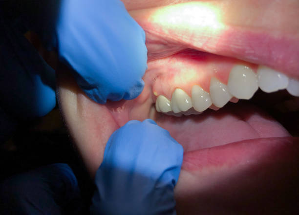 Best Emergency Denture Repair in Buckner, MO